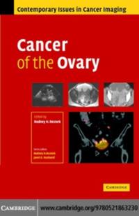 Cancer of the Ovary