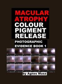 Macular Atrophy Colour Pigment Release, Photographic Evidence Book 1