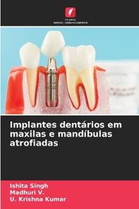 Implantes dentários em maxilas e mandíbulas atrofiadas