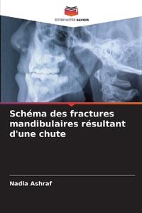 Schéma des fractures mandibulaires résultant d'une chute