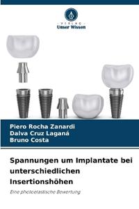 Spannungen um Implantate bei unterschiedlichen Insertionshöhen