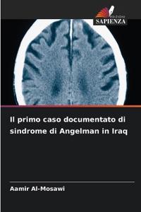 Il primo caso documentato di sindrome di Angelman in Iraq