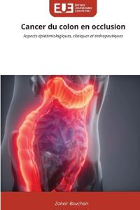 Cancer du colon en occlusion