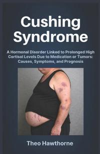 Cushing Syndrome